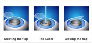 What Is The Procedure Of Lasik?