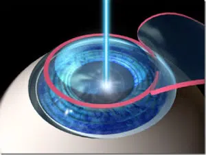 What Is Lasik?