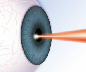 What Are Some Lasik Options?